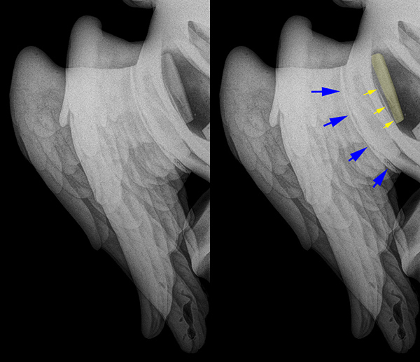 Radiograph of Boreas Abducting Orithyia